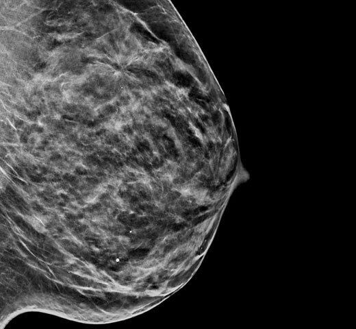 Immagini Sintetiche C-View™ Hologic su sfondo bianco