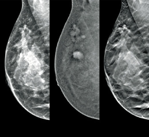 Imaging con Contrasto I-View™ di Hologic