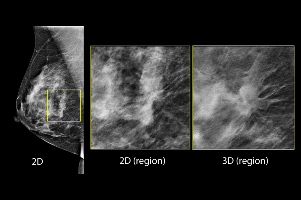 Immagini cliniche di una mammografia con lesione sospetta