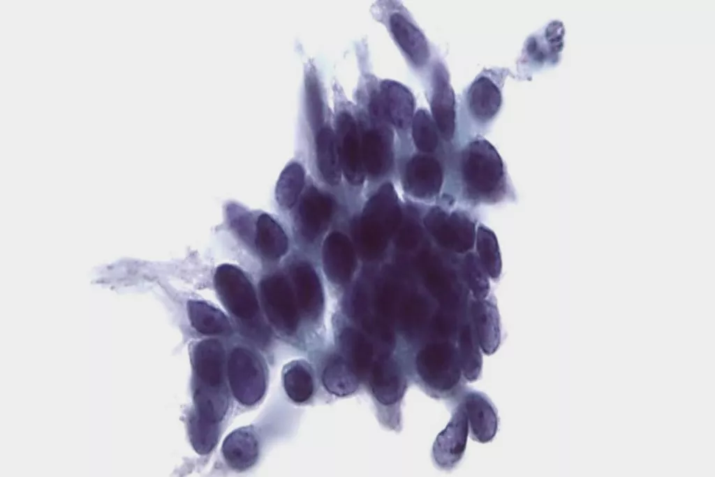 Scansione pap test di neoplasia intraepiteliale ghiandolare cervicale