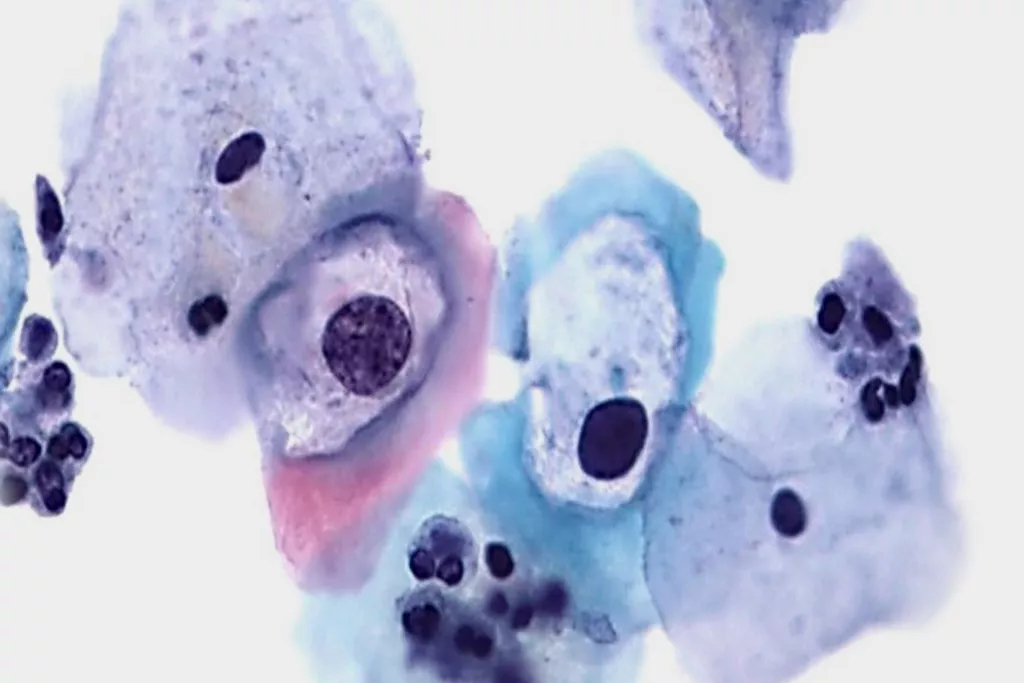 Scansione pap test di discariosi di basso grado con HPV