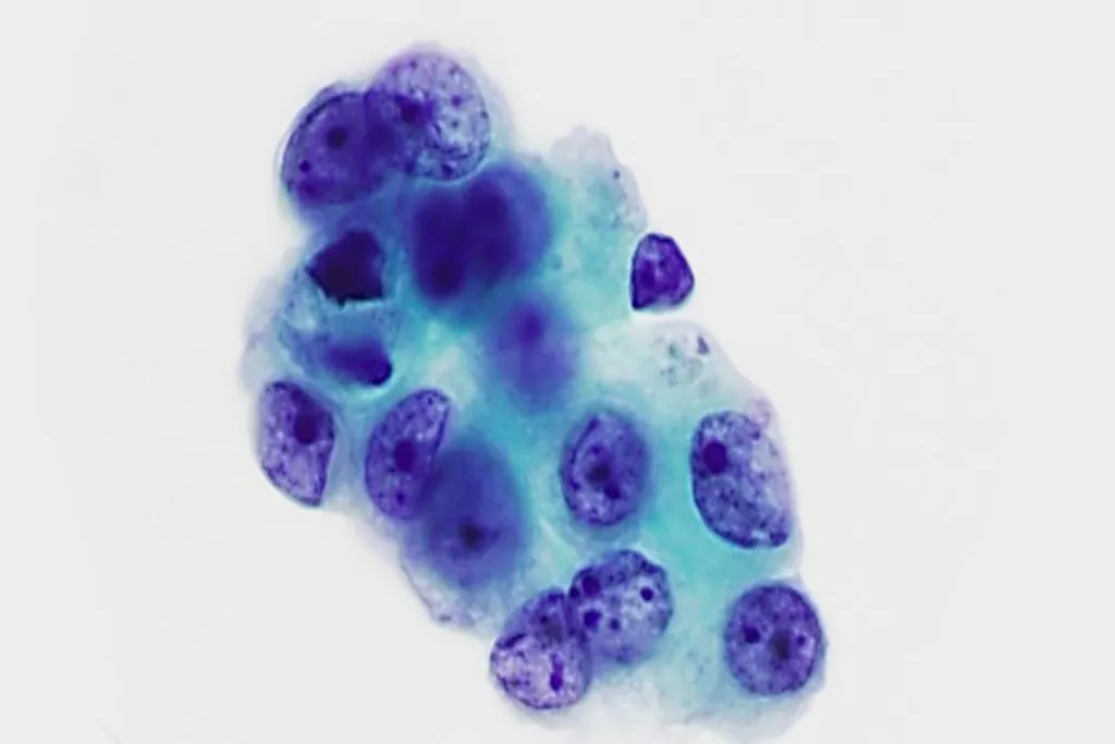Adenocarcinoma, lavaggio bronchiale, colorazione di Papanicolaou