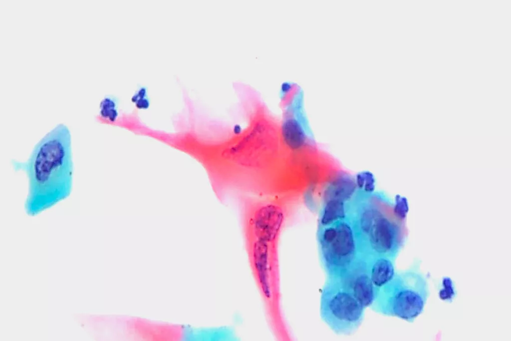 Carcinoma squamoso, urina, colorazione di Papanicolaou