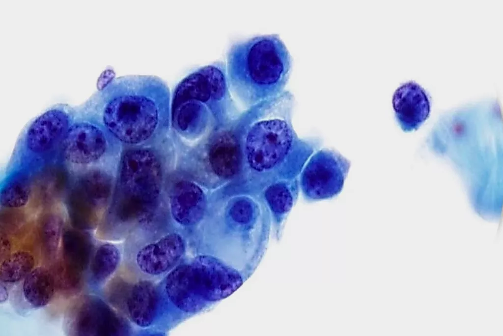 carcinoma a cellule transizionali, grado 3, urina, colorazione di Papanicolaou